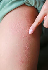 Close-up Allergic rash dermatitis eczema on woman leg.