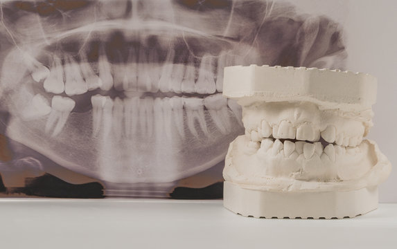 Dental casting gypsum model of human jaws with panoramic dental x-ray . Crooked teeth and distal bite. Shots were made before treatment with braces.