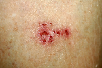 Wound on the skin. Psoriasis, dermatitis, eczema.