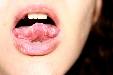 Thrush in the tongue of the child. Candida