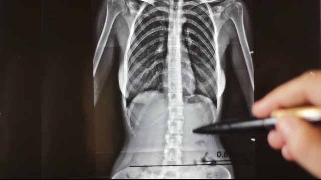 Doctor examines an x-ray of woman spine with lombar scoliosis