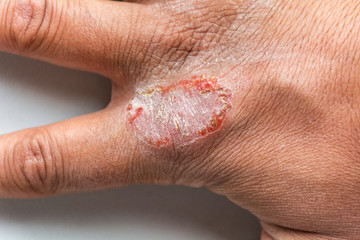 Naklejka premium Hand With Atopic Dermatitis Eczema Psoriasis Vulgaris