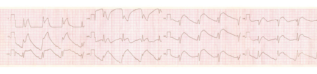 ECG tape with changes in acute pericarditis