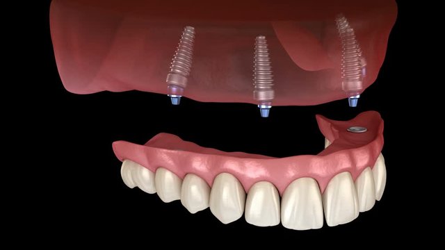 Maxillary prosthesis All on 4 system supported by implants. Medically accurate 3D animation of human teeth and dentures concept