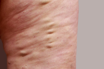 Fototapeta premium The varicose veins