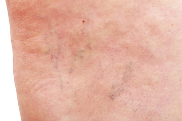 The varicose veins