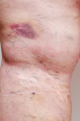 The varicose veins