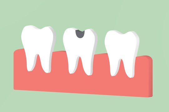 decay tooth or dental caries - teeth cartoon 3d render