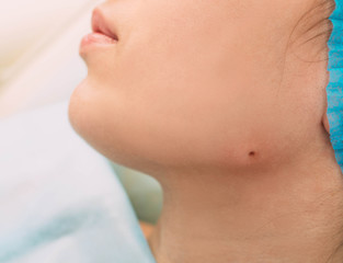 skin area , after mole radio wave electrocoagulation removing. Part of series mole removing