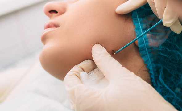 Patient getting mole removing with electrocautery and surgical tweezers on her face. Radio wave electrocoagulation remove method