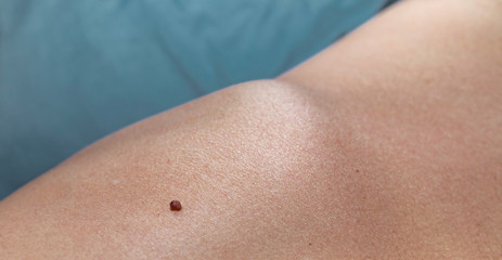 Brown Raised Skin Mole