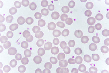 Red blood cells and platelet in blood smear, analyze by microscope