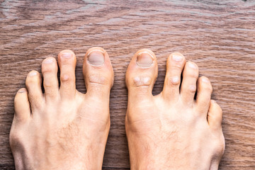 Feet of barefoot man with psoriasis dermatitis on his fingers. - obrazy, fototapety, plakaty