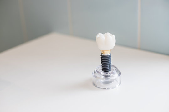 teeth model showing an implant crown bridge model .Dental Industry. Dental Implant or endosseous tooth prosthetic concept with an orthodontic crown abutement isolated .orthodontist dentistry surgery