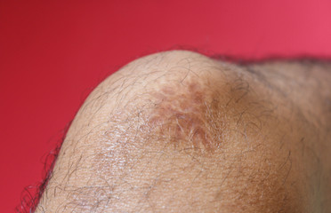 Naklejka premium Close up keloid scar on skin