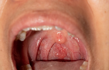 Sore throat with throat swollen. Closeup open mouth with posterior pharyngeal wall swelling and uvula and tonsil. Influenza follicles in the posterior pharyngeal wall. Upper respiratory tract.