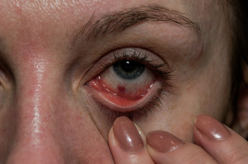 Inflamed with conjunctivitis disease eye of a young girl
