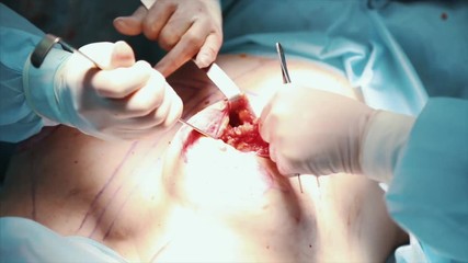 Breast implant. Removal of a malignant tumor of the mammary gland. Installation of a breast implant after removal of a cancerous tumor, close up