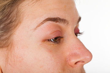 Fototapeta premium Hordeolum on upper eyelid. Viral infection