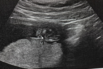 Ultrasound of baby in mother's at hospital.