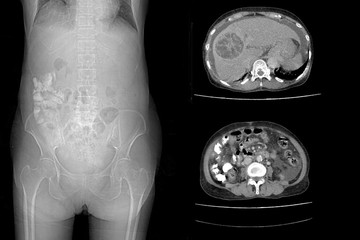 CT whole abdomen show hepatocarcinoma - obrazy, fototapety, plakaty