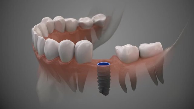 Toth human implant. On1 concept. Dental prosthetic innovation.  3d rendering