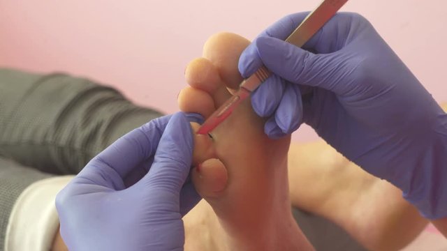 Podology or pedicure treatment. Podologist removing a corn and dead skin from client's toe with a scalpel.