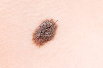 Mole on skin