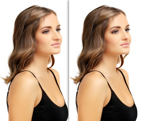 Rhinoplasty.Before and after