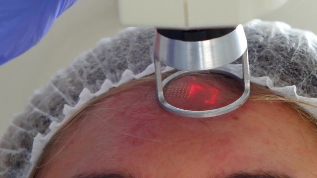 Acne laser face treatment close up.