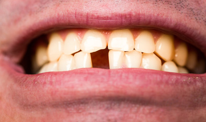 Yellow bad teeth. Man without one front tooth. No teeth. Smile men with a lost front tooth, toothache. Yellow teeth. Bad dental health, no teeth, no fluoride, tooth erosion