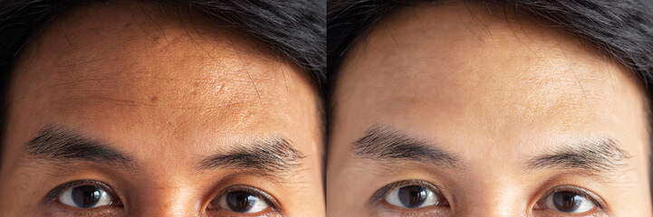 two pictures compared effect Before and After treatment. skin with problems of freckles , pore ,...