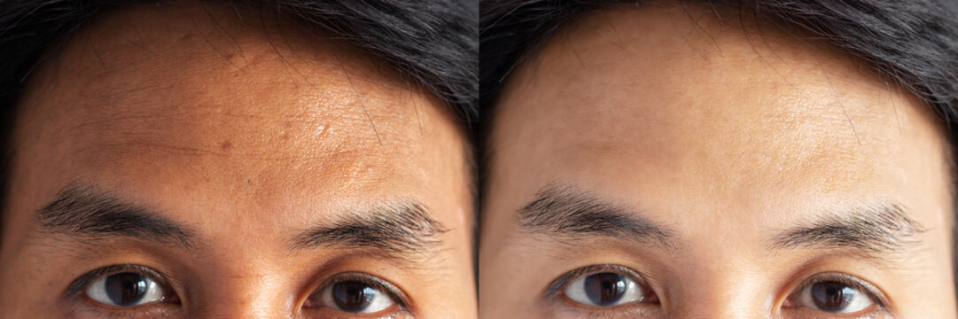 two pictures compared effect Before and After treatment. skin with problems of freckles , pore , dull skin and wrinkles around forehead before and after treatment to solve skin problem for better skin