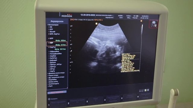 Docotr pointing the baby's head on ultrasound screen