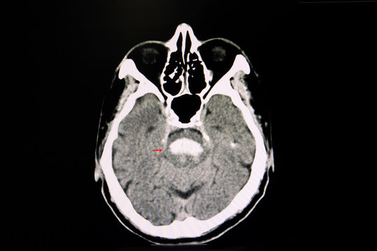 brain stem hemorrhage