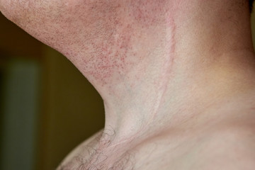 Scar on the neck of a man after removal of the thyroid gland