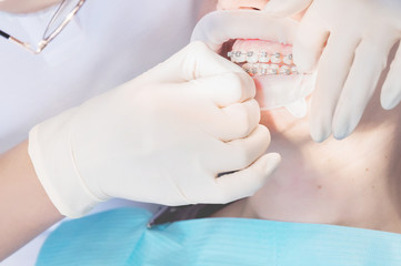 Extreme macro closeup of open female human mouth showing stainless steel braces. Inspection of the installation and removal of braces by the dentist
