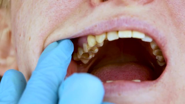 The hole in the tooth and the treatment of dental canals. Treatment of periodontitis in the dental clinic