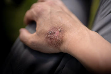 Burn form hot steam, in the picture it has been about a week and now the skin is starting to drop...