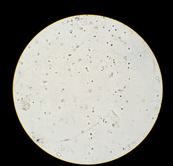 Urinalysis analysis shown crystal under microscopic 
