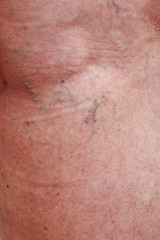 Fototapeta premium The varicose veins