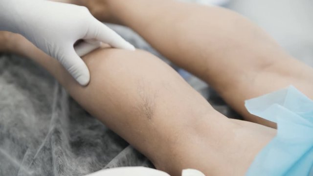 Close-up hands of phlebologist in gloves disinfect leg of patient with varicose veins before sclerotherapy procedure