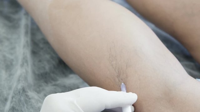 Close-up hands of phlebologist in gloves does procedure of sclerotherapy on leg of patient