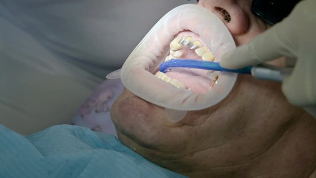 Close-up Suction Of Fluid From The Dentist's Patient's Mouth During Prosthetics