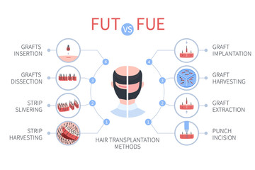 FUE vs FUT medical infographics. Follicular unit extraction versus follicular unit transplantation. Types of hair transplant procedures and their stages. Male alopecia treatment. Vector illustration. - obrazy, fototapety, plakaty