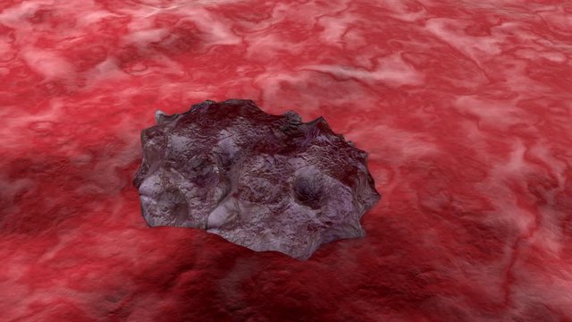 3D rendered animation of a growing Cancer Tumor on healthy tissue.