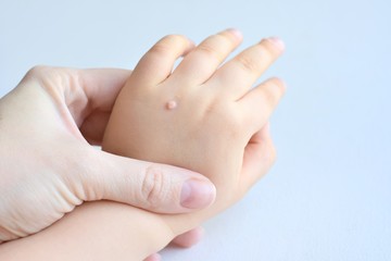 The doctor holds a small hand of a child affected with warts on little fingers and back of the hand. Papillomavirus in a child's hand and fingers. Pediatric dermatology. Skin diseases - obrazy, fototapety, plakaty