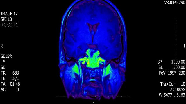 Real life man brain mri scan with tumor neoplasm medical reseach new quality health science 4k footage stock animation screen .