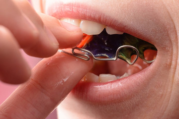 A big plan for dressing a metal plate for tooth bristling