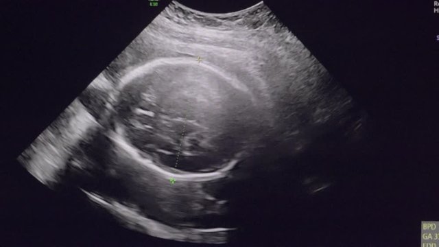 4d scan Pregnant Ultrasound of a baby fetus at 23 weeks 